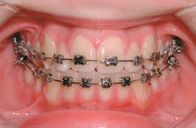 Tooth Braces