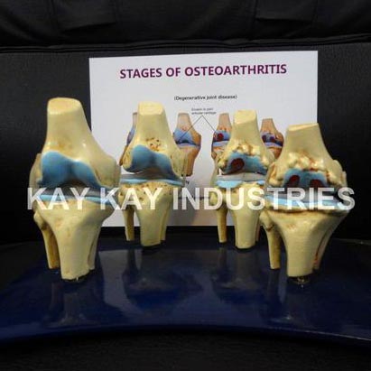 Knee Model Depicting Osteoarthritis