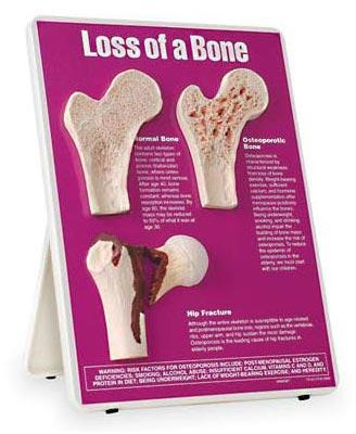 Loss Of Bone Model