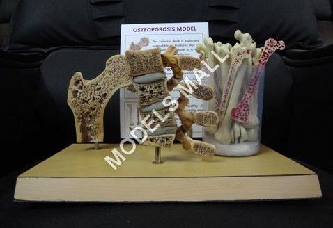 Osteoporosis Model Bone Set