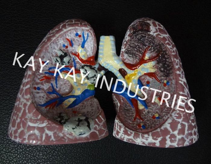 Pathological Lungs Model
