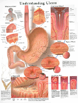 Understanding Ulcers