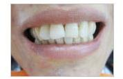 Crooked Tooth Correction