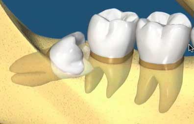 Impacted Teeth Removal