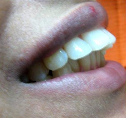 Jetting Out Teeth Correction
