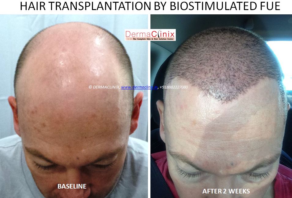 Hair Transplant Services - DermaClinix - The Complete Skin & Hair Solution  Center, Delhi, Delhi