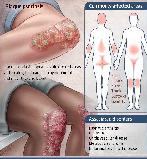 Psoriasis chronic skin treatments
