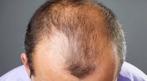 Alopecia Hair Wig services