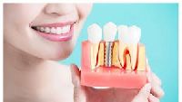 dental implant service