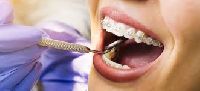 Orthodontic Treatments: Teeth Alignment