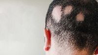 Alopecia Areata Treatment