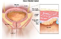 Urinary Bladder Cancer Treatment