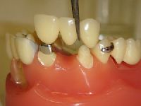Crowns and Bridge Dentistry Treatment Services