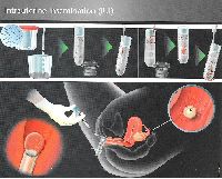 IUI Treatment Surat