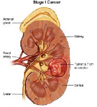 Kidney Cancer Uro Oncology Treatment Services
