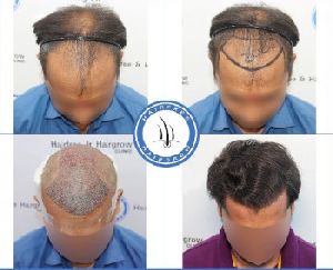 Best Hair Transplant Clinic In India