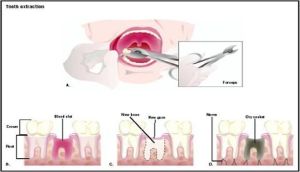 Extraction of Teeth Dental Services