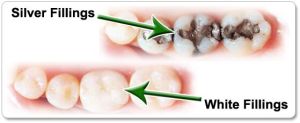 Tooth Filling Treatment Services