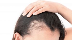 Female Pattern Baldness Treatment