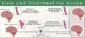 Stem Cell Treatment to Stroke