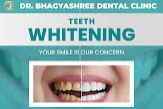 Teeth Whitening Services