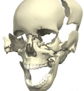 Disarticulated Skull