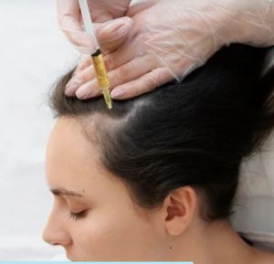 Platelet-Rich Fibrin (PRF) Therapy Treatment For Hair Regrow