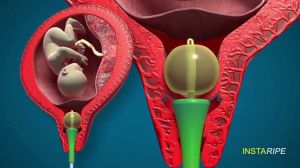 Panicker's Rapid Cervical Ripening Device