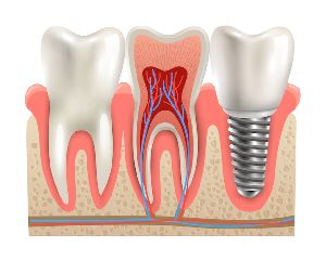 Painless Root Canal Treatment