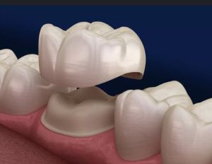 Dental Crowns