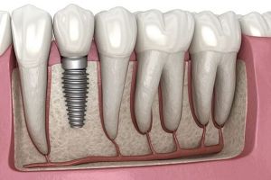 Titanium Dental Implant