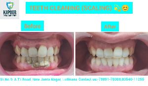 Teeth Scaling Services