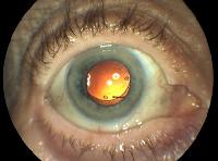 Intraocular Lenses