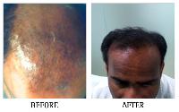 Hair Fall Clinic in Bangalore