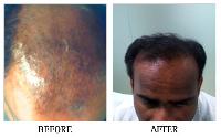 Prp for Hair Loss in Bangalore, Platelet Rich Plasma for Hair Loss