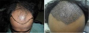 Hair Tranceplante & treatment