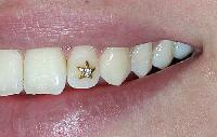 tooth jewellery
