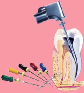 Cleaning The Prepared Tooth