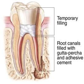 Root Canal Sealing