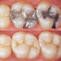 TOOTH COLOURED FILLINGS