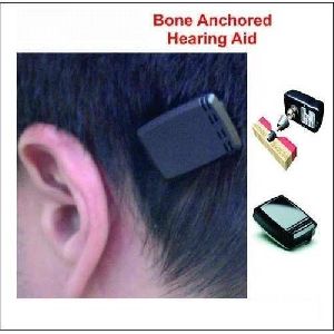 Bone Anchored Hearing Aids