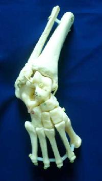 Articulated Club Foot Model