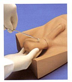 No Scalpel Vasectomy No Scalpel Vasectomy