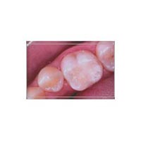 Cosmetic Tooth Colored Fillings