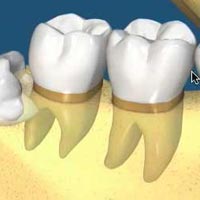 Impacted Teeth Removal