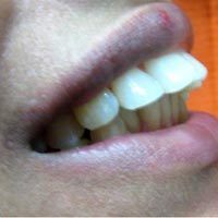 Jetting Out Teeth Correction