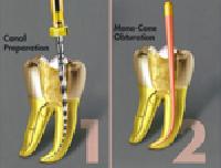 endodontic treatment