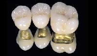 dental alloys