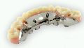 Dental Implant Hybrid Restorations