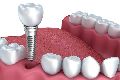 Dental Implant Treatment Services